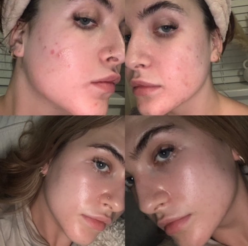 Breakout Kit | Skincare Routine for Blemish-Prone & Dehydrated Skin